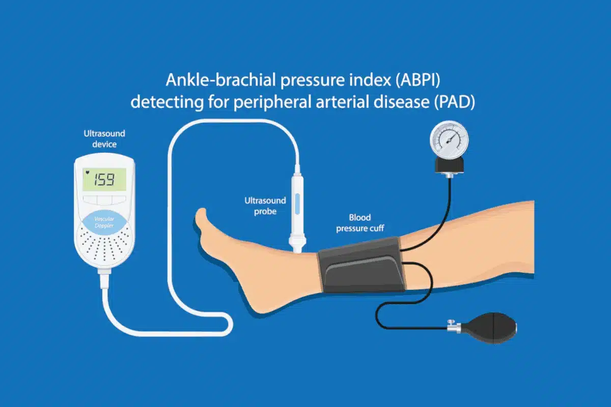 Ankle Brachial Index